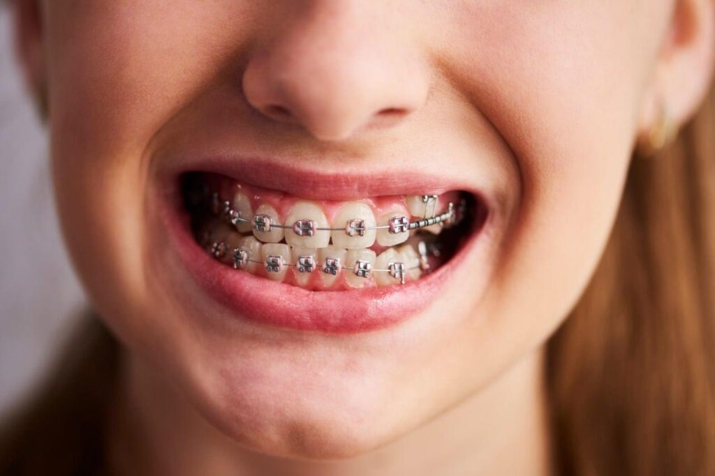 Apparecchio ai denti a Napoli: guida completa per bambini e adulti